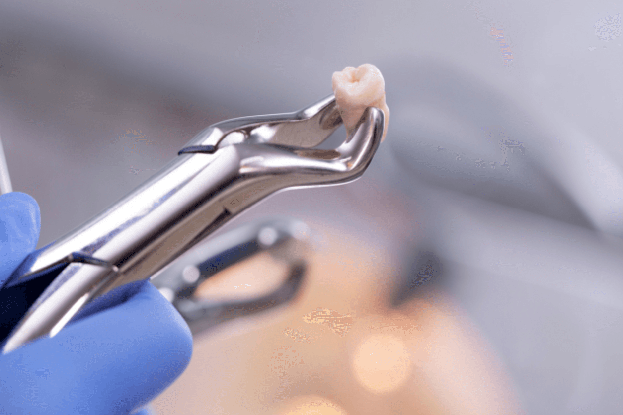 What You Need To Know About Wisdom Teeth Removal